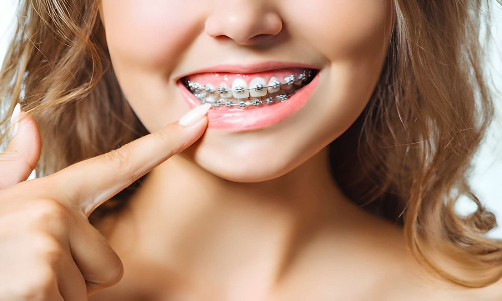 Reasons to Pick Traditional Metal Braces