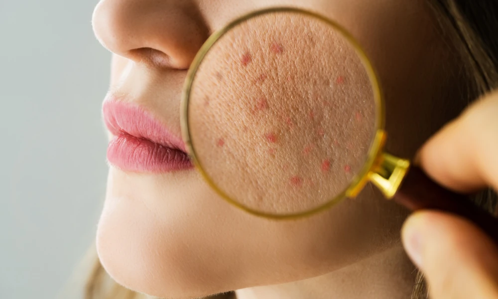 Best Dermatologist in India for Acne, Pigmentation & Hair Loss